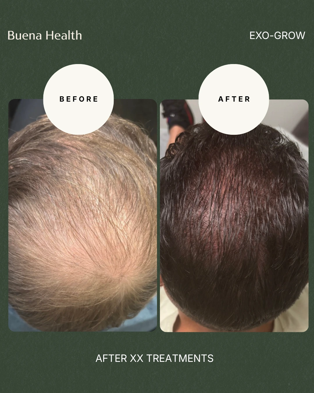 ExO-Grow scalp treatment before and after result showing fuller crown coverage