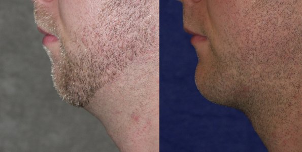 Chin augmentation before and after photographs, case 2, with the before photograph on the left and the after photograph on the right