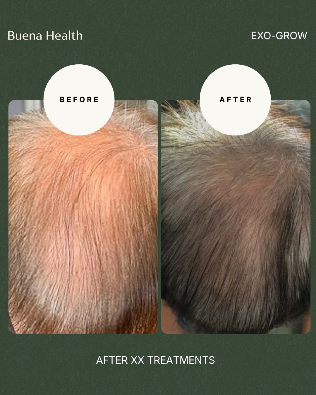 ExO-Grow scalp treatment before and after result showing improved hair density