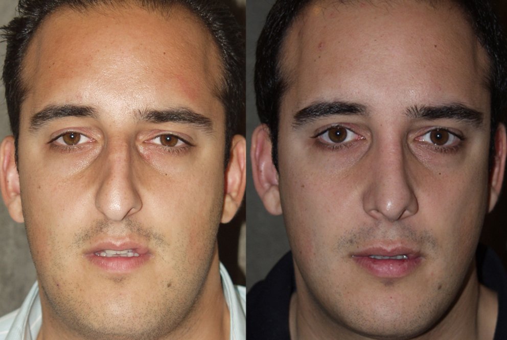 Rhinoplasty before and after photographs, case 1, with the before photograph on the left and the after photograph on the right