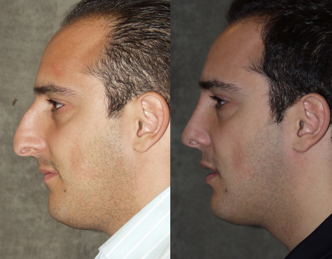 Rhinoplasty before and after photographs, case 2, with the before photograph on the left and the after photograph on the right