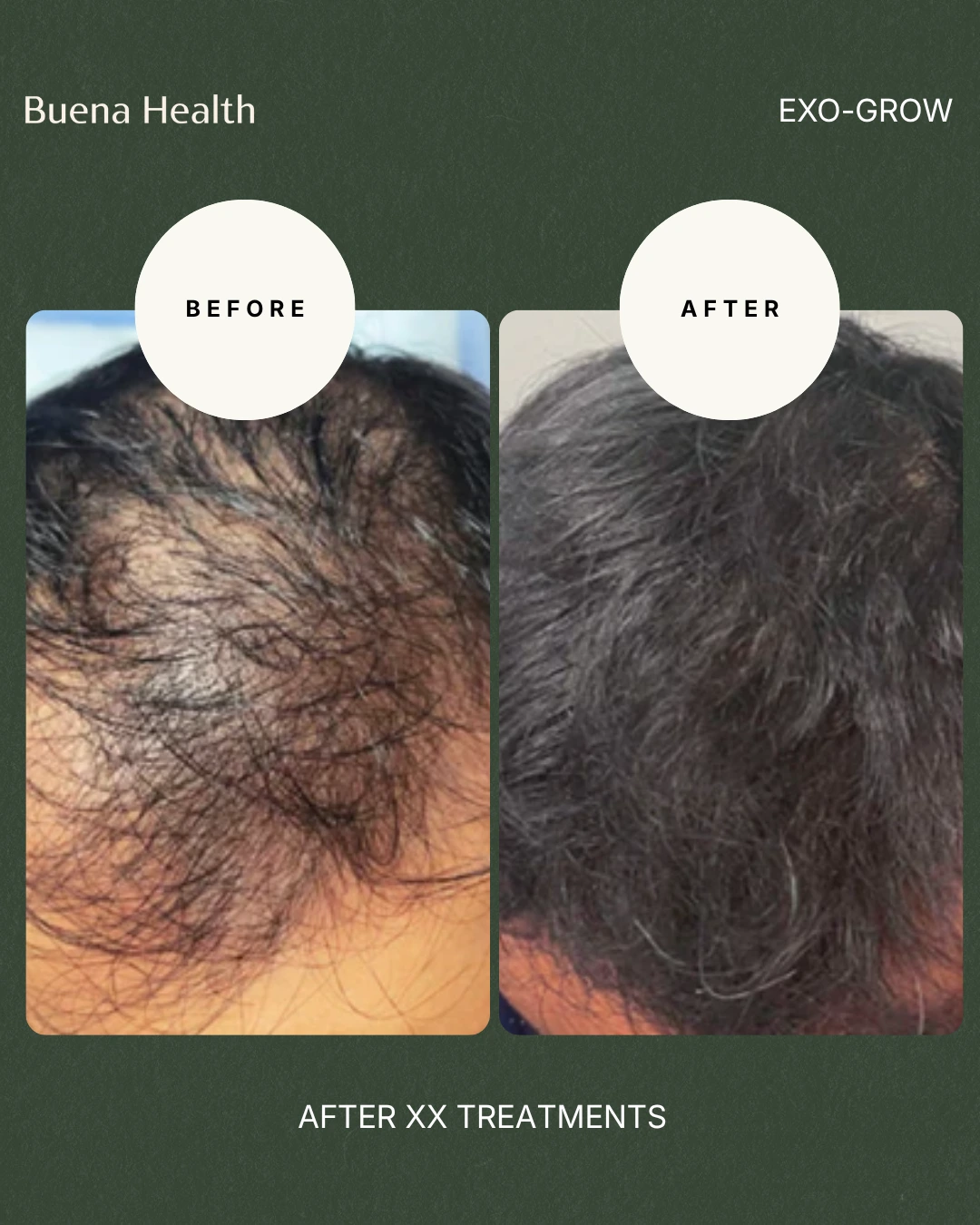 ExO-Grow scalp treatment before and after result showing improved hair density