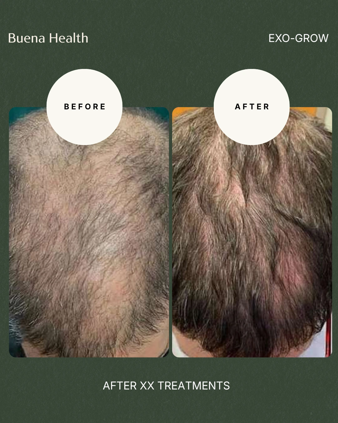 ExO-Grow scalp treatment before and after result showing improved crown coverage