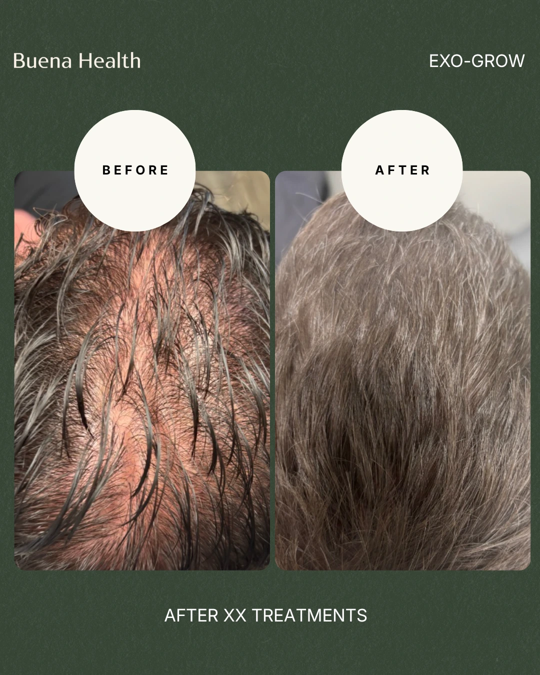 ExO-Grow scalp treatment before and after result showing improved crown coverage
