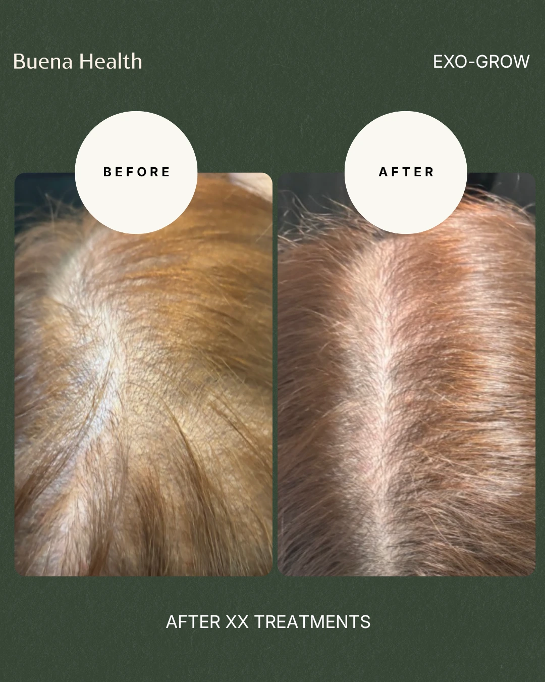 ExO-Grow scalp treatment female patient before and after showing improved part-line density