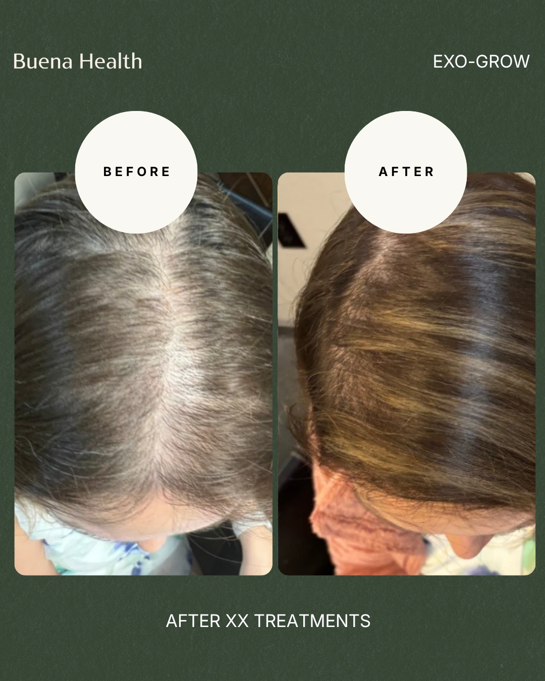 ExO-Grow scalp treatment female patient before and after showing improved crown density