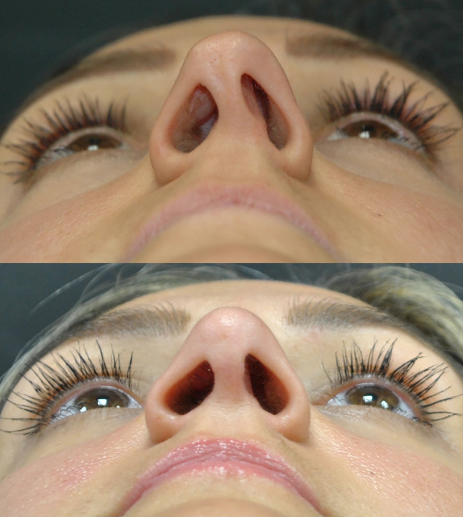 Dr. Kirwan patient result — Dr. Laurence Kirwan. Crooked nose, rhinoplasty with septoplasty, 3 months post-op, view from below showing the healed incision. Before: top; After: bottom.
