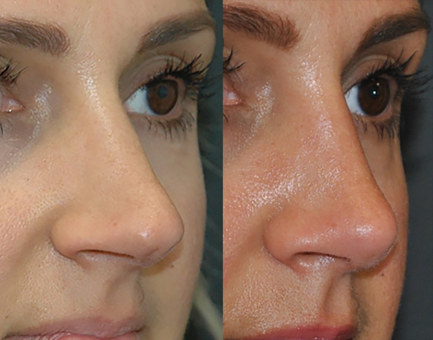 Dr. Kirwan patient result — Dr. Laurence Kirwan. Crooked nose, rhinoplasty with septoplasty, 3 months post-op, oblique close-up. Before: left; After: right.