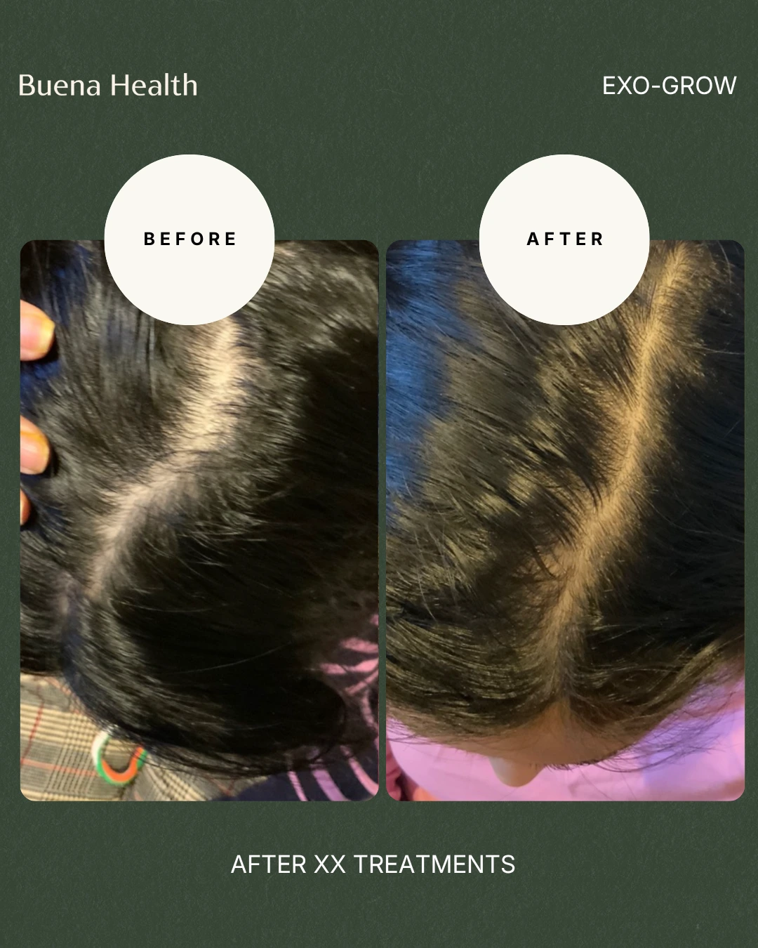 ExO-Grow scalp treatment female patient before and after showing fuller hair along the part