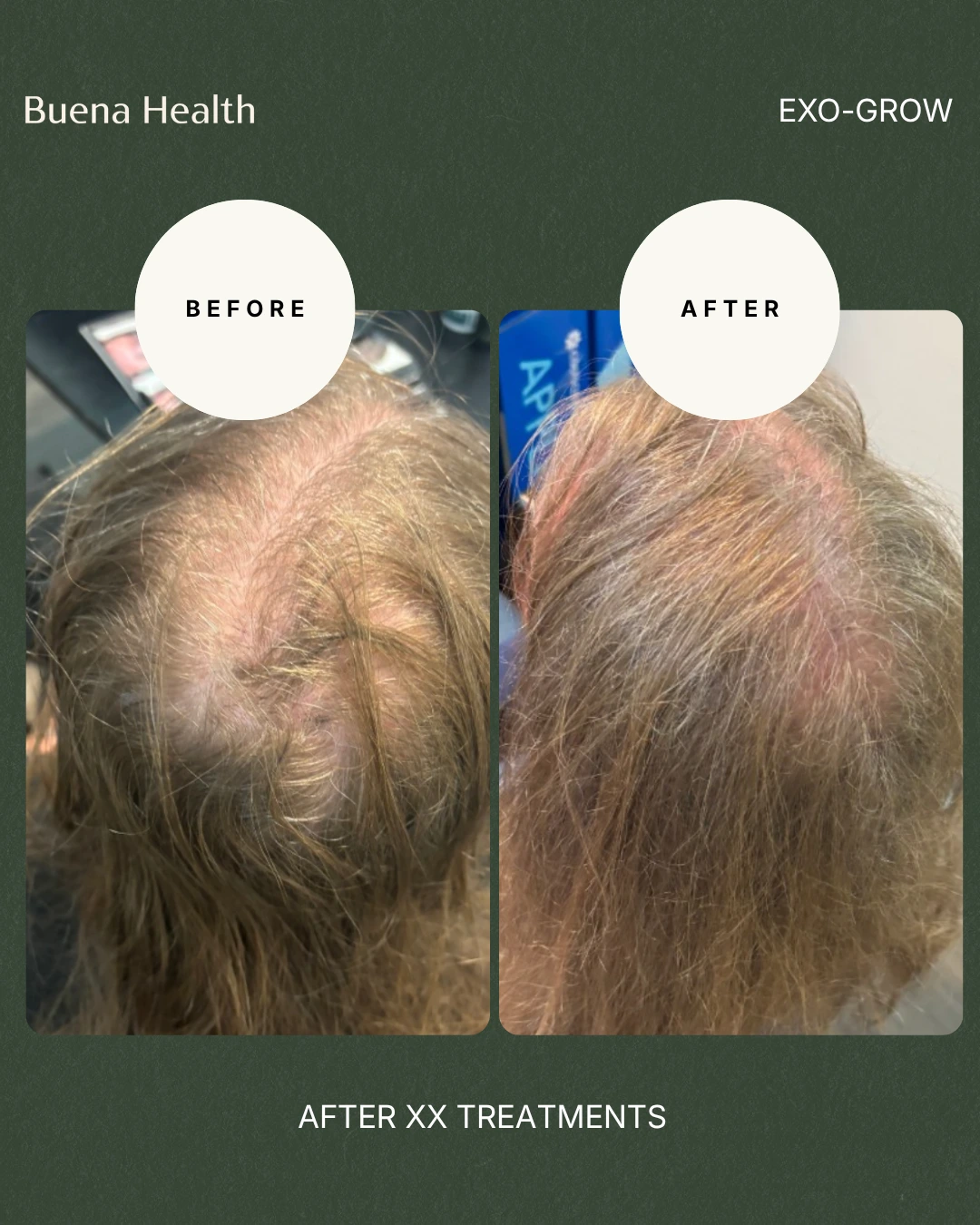 ExO-Grow scalp treatment female patient before and after showing fuller hair coverage