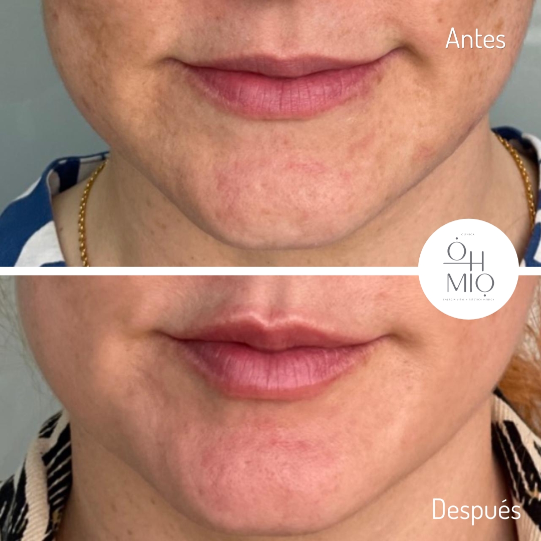 Antes y después de diseño de labios con ácido hialurónico, caso 6
