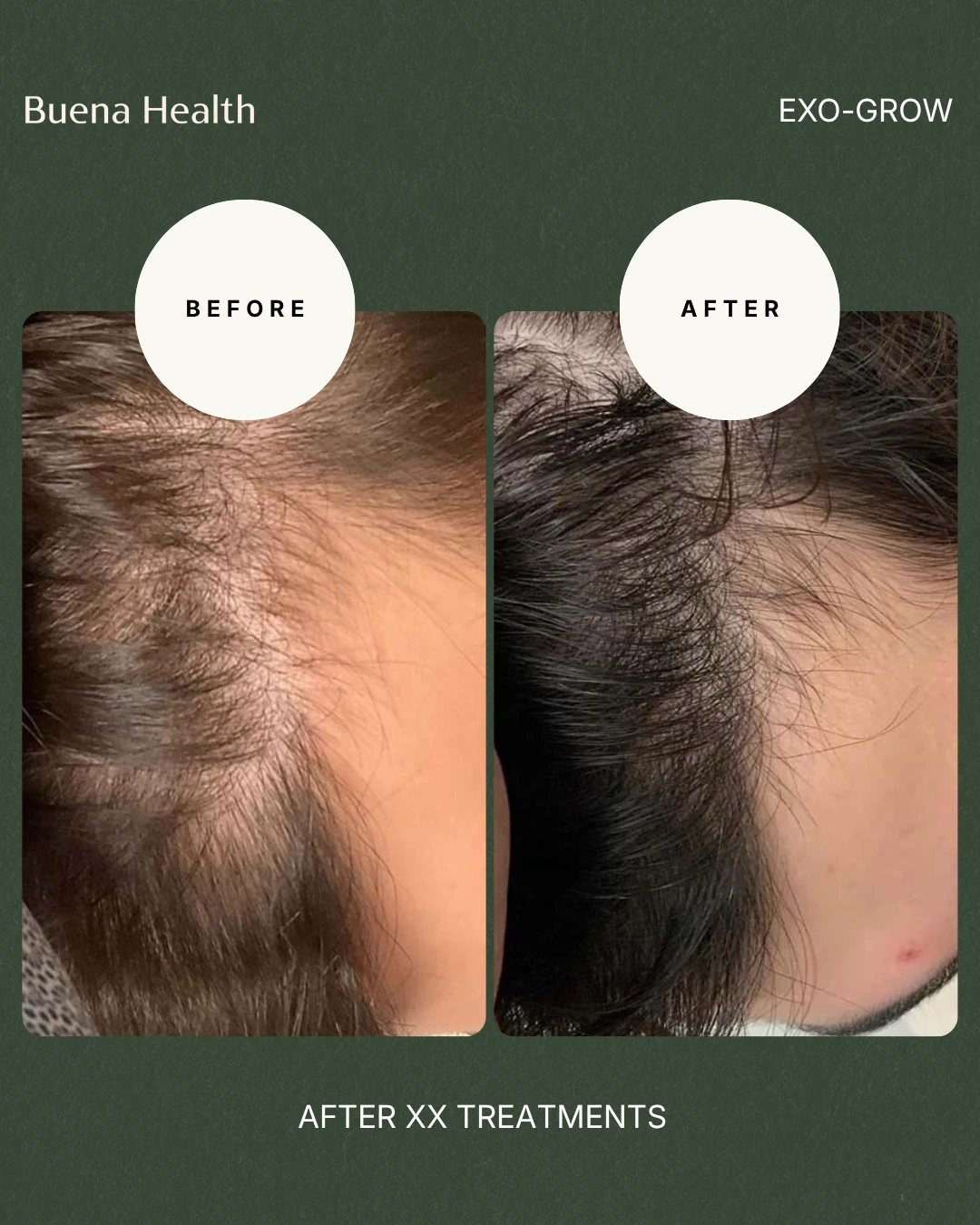 ExO-Grow scalp treatment before and after result showing improved frontal coverage