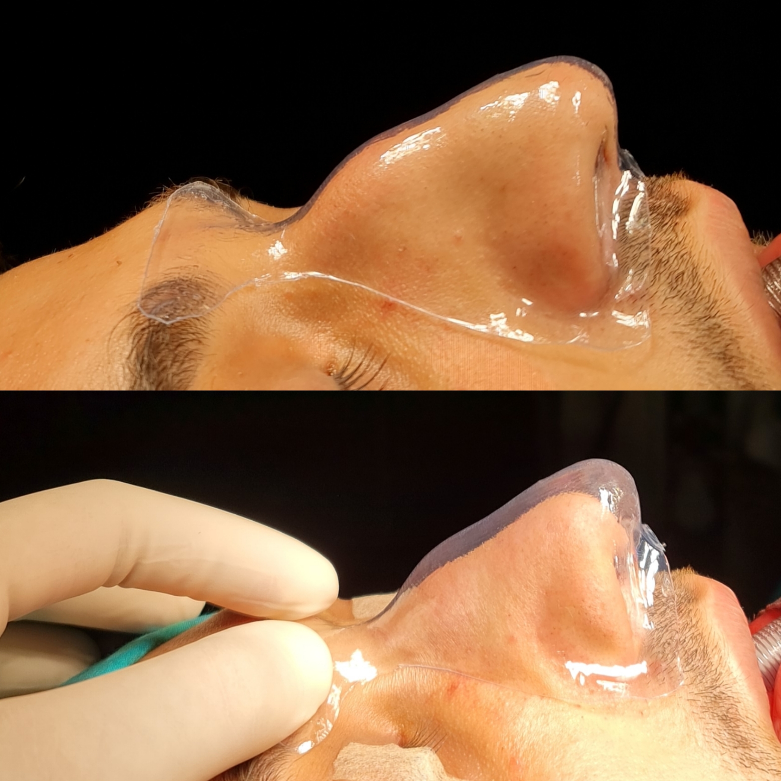 Burun estetiği simülasyonu