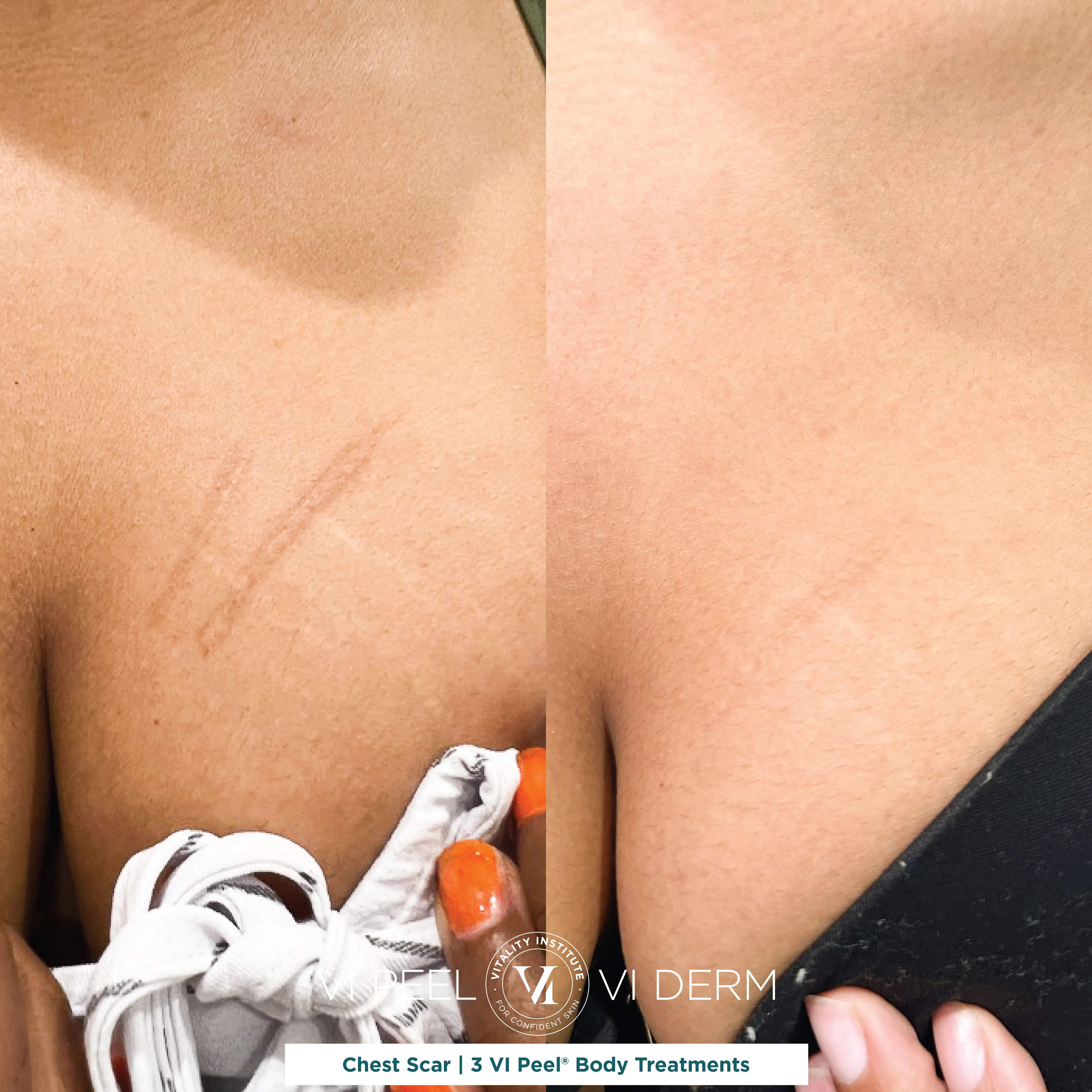Chest Scar — 3 VI Peel Body Treatments