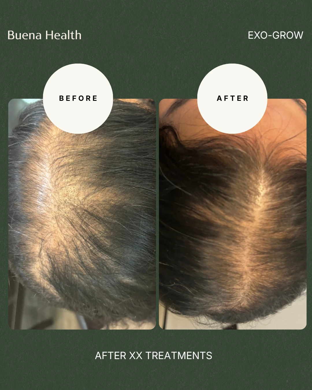 ExO-Grow scalp treatment female patient before and after showing improved part-line coverage