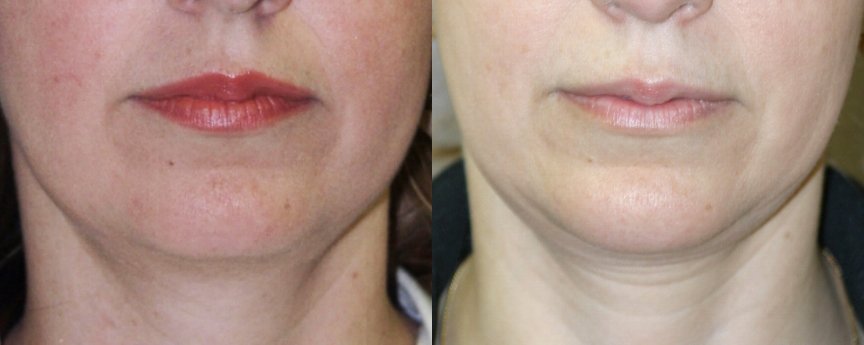 Chin augmentation before and after photographs, case 3, with the before photograph on the left and the after photograph on the right