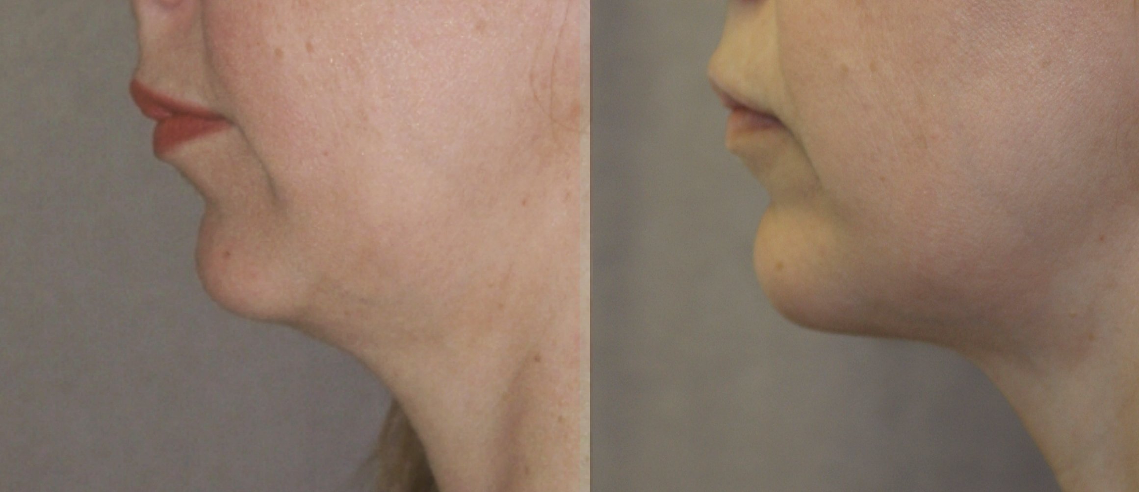 Chin augmentation before and after photographs, case 5, with the before photograph on the left and the after photograph on the right