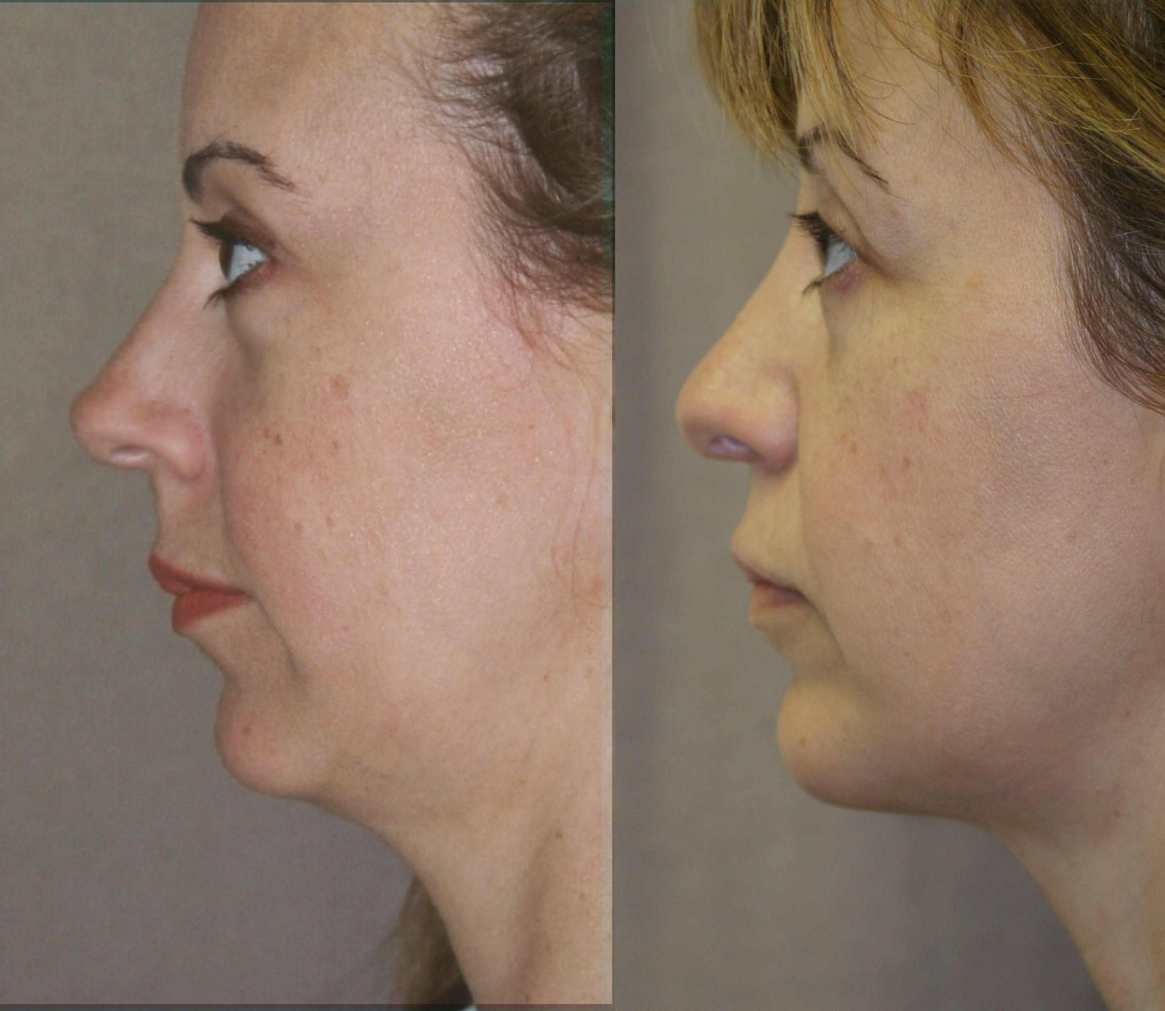 Chin augmentation before and after photographs, case 4, with the before photograph on the left and the after photograph on the right