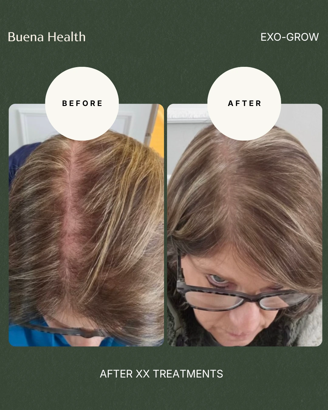 ExO-Grow scalp treatment female patient before and after showing improved crown fullness