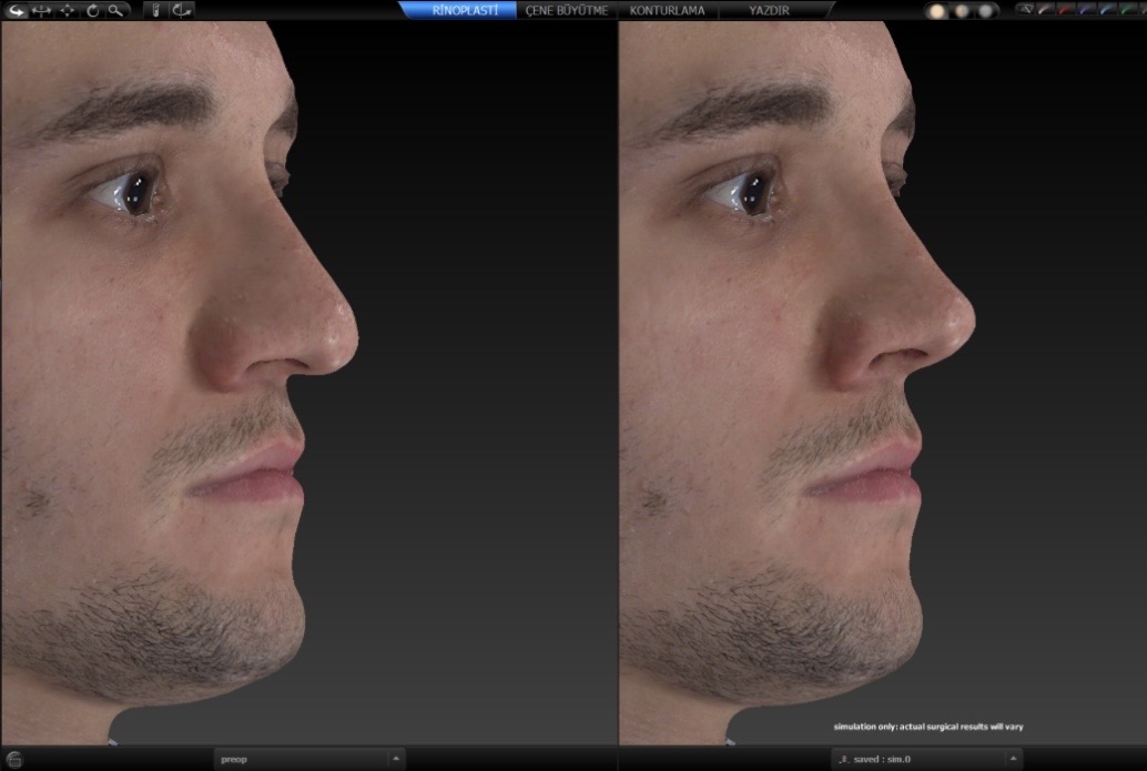 Burun estetiği simülasyonu