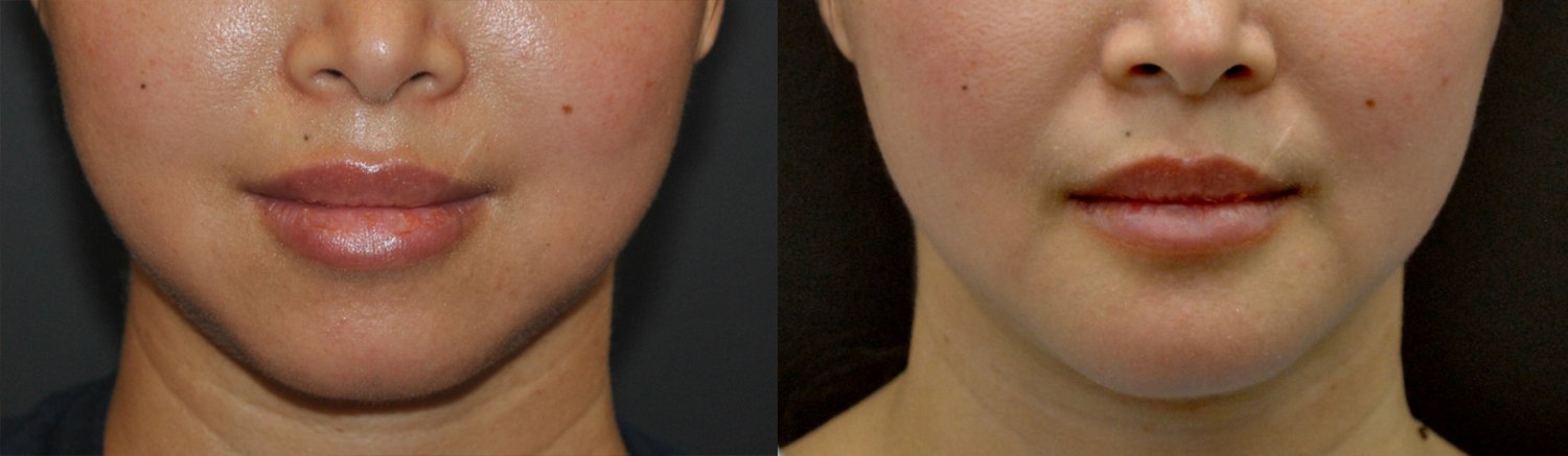 Chin augmentation before and after photographs, case 6, with the before photograph on the left and the after photograph on the right