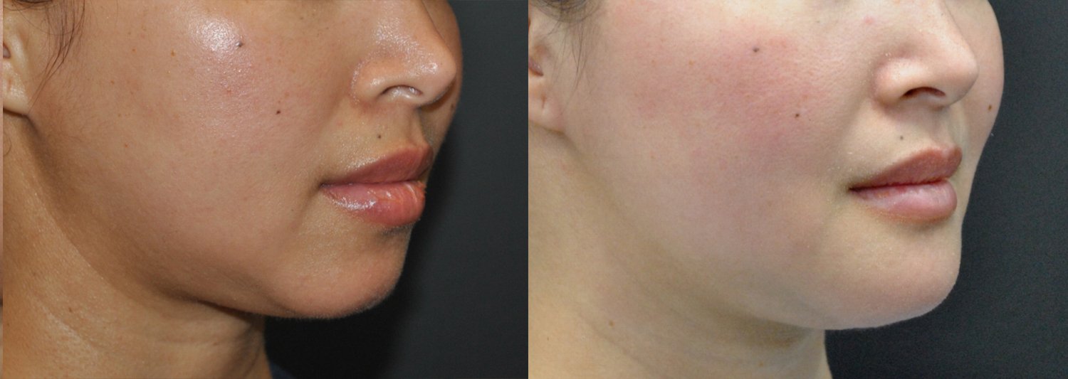 Chin augmentation before and after photographs, case 7, with the before photograph on the left and the after photograph on the right