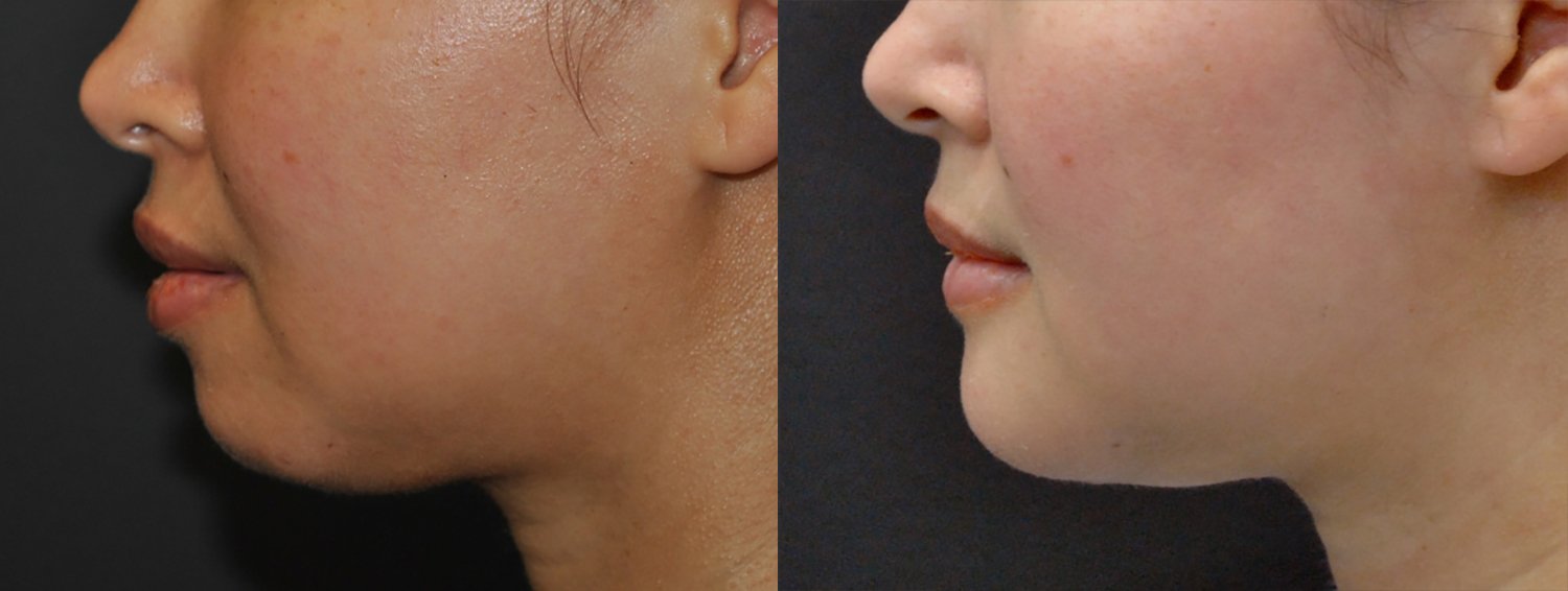 Chin augmentation before and after photographs, case 8, with the before photograph on the left and the after photograph on the right