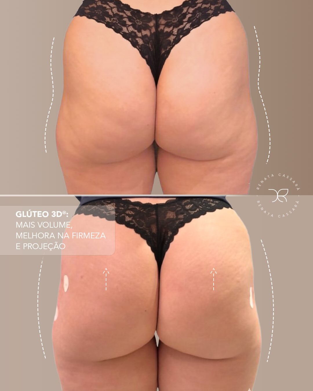 Resultado Glúteos 3D - Mais volume, melhora na firmeza e projeção