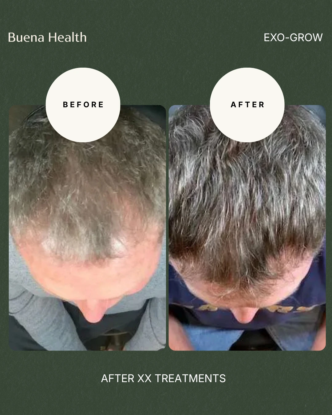 ExO-Grow scalp treatment before and after result showing improved hair density