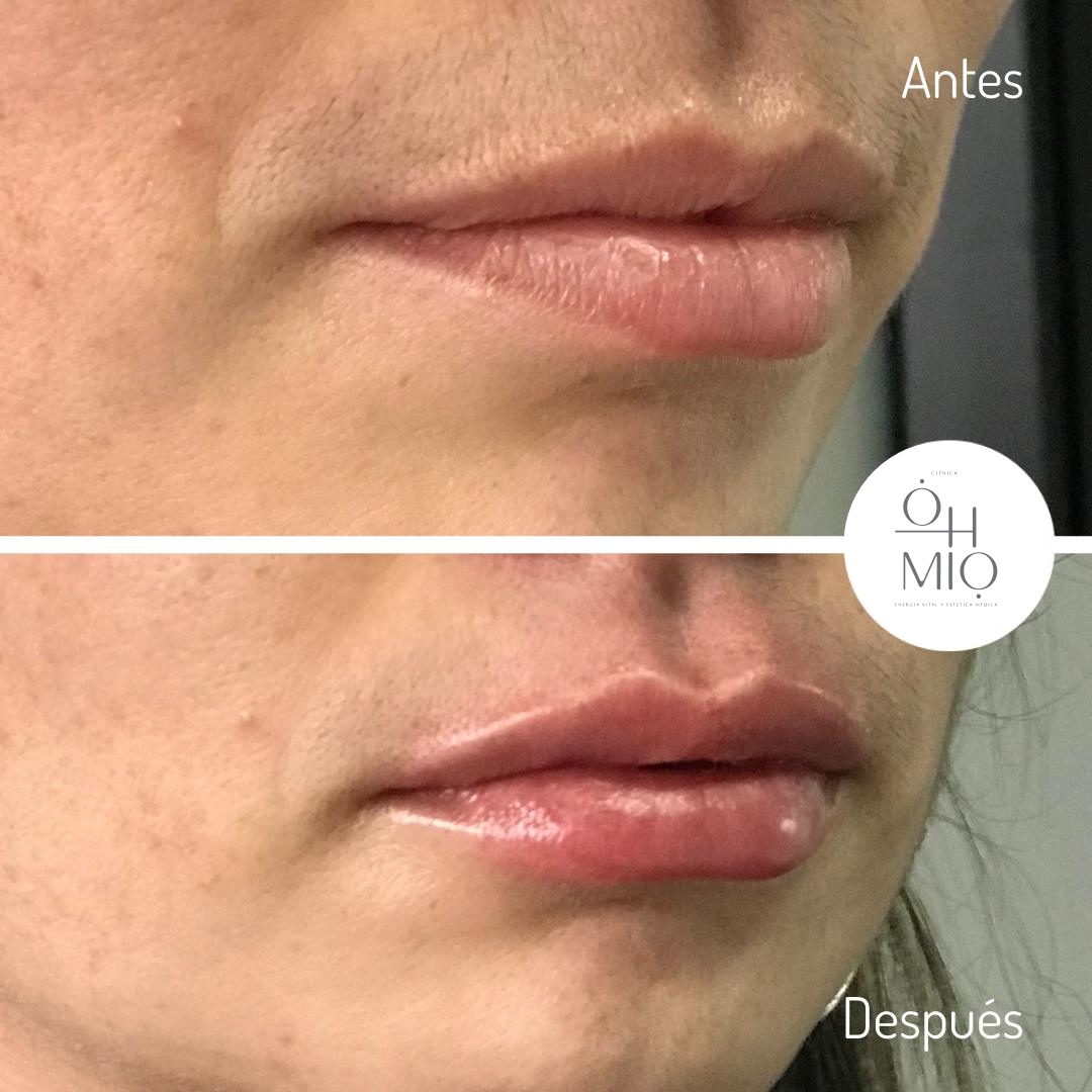 Antes y después de diseño de labios con ácido hialurónico, caso 5