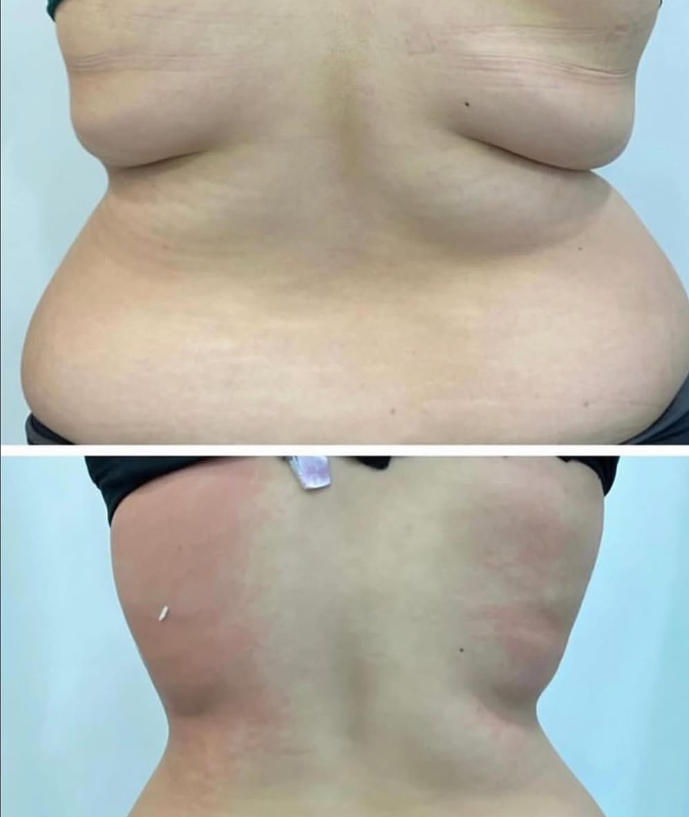 G9 Body Contouring & Cellulite — Before & After 6