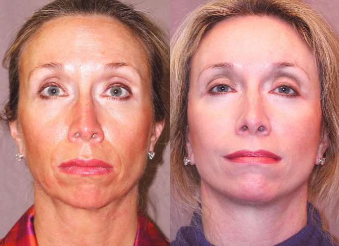 Facelift before and after photographs, case 1, with the before photograph on the left and the after photograph on the right