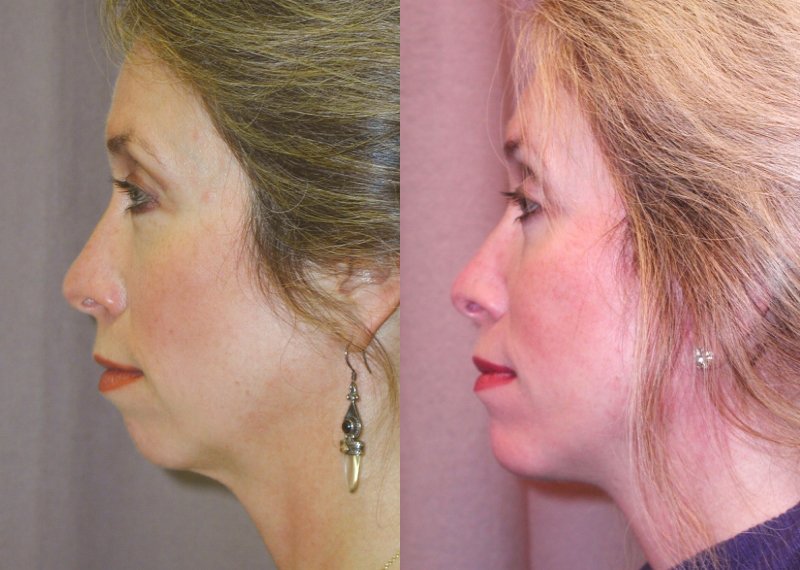 Facelift before and after photographs, case 2, with the before photograph on the left and the after photograph on the right
