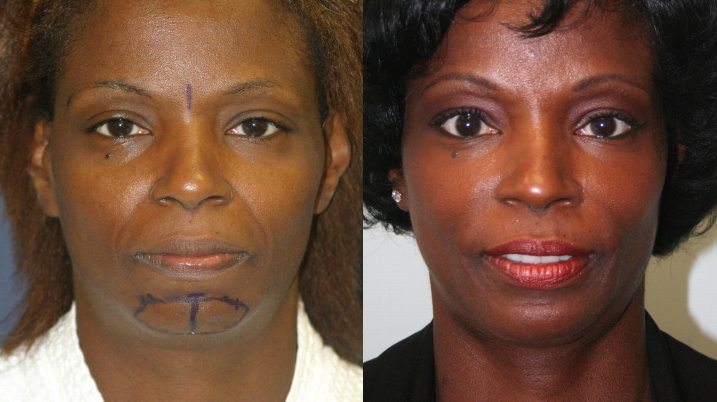 Chin augmentation before and after photographs, case 9, with the before photograph on the left and the after photograph on the right