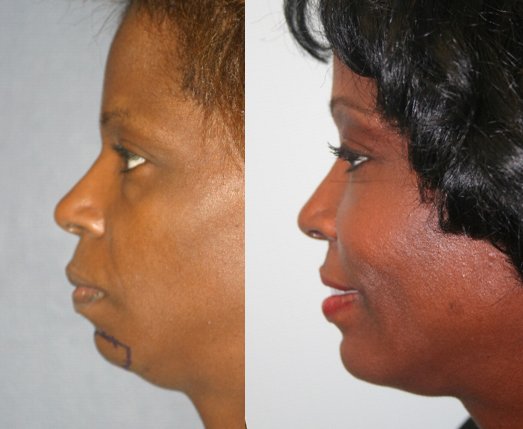 Chin augmentation before and after photographs, case 10, with the before photograph on the left and the after photograph on the right