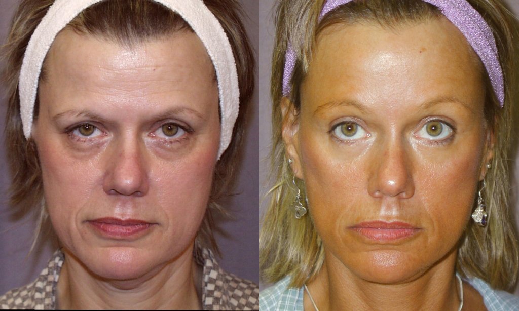 Facelift before and after photographs, case 5, with the before photograph on the left and the after photograph on the right