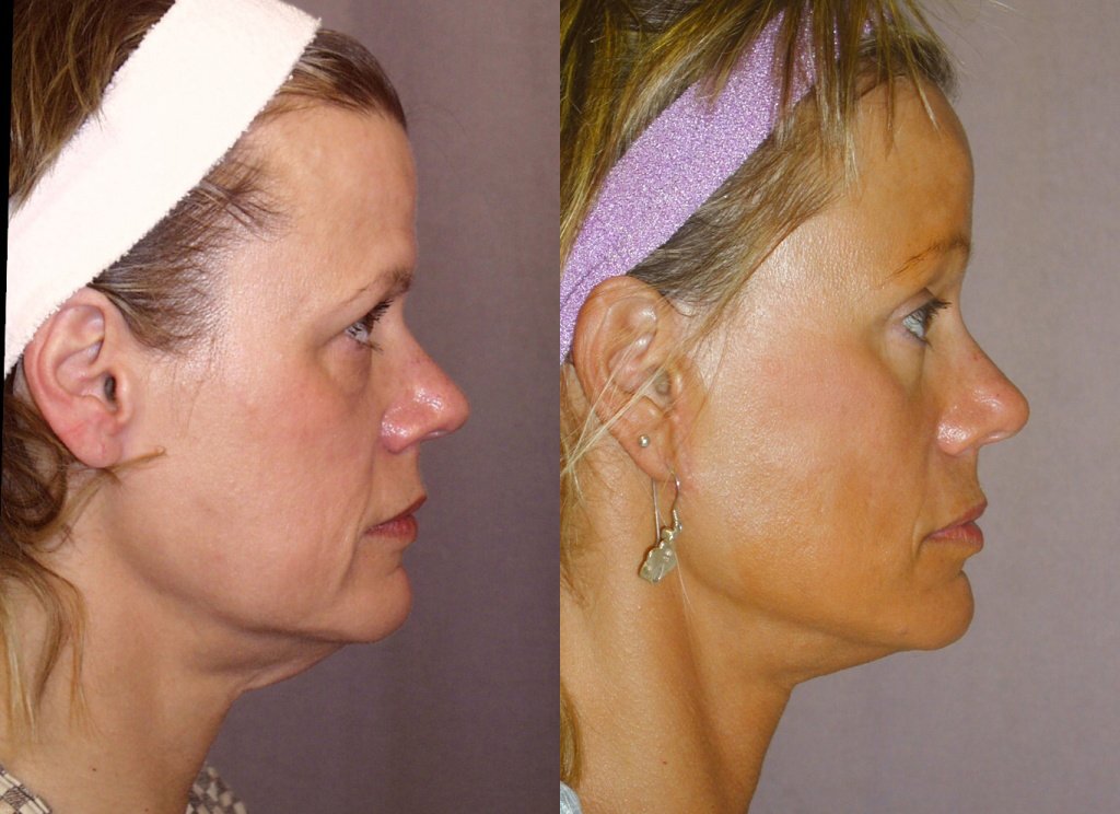 Facelift before and after photographs, case 6, with the before photograph on the left and the after photograph on the right