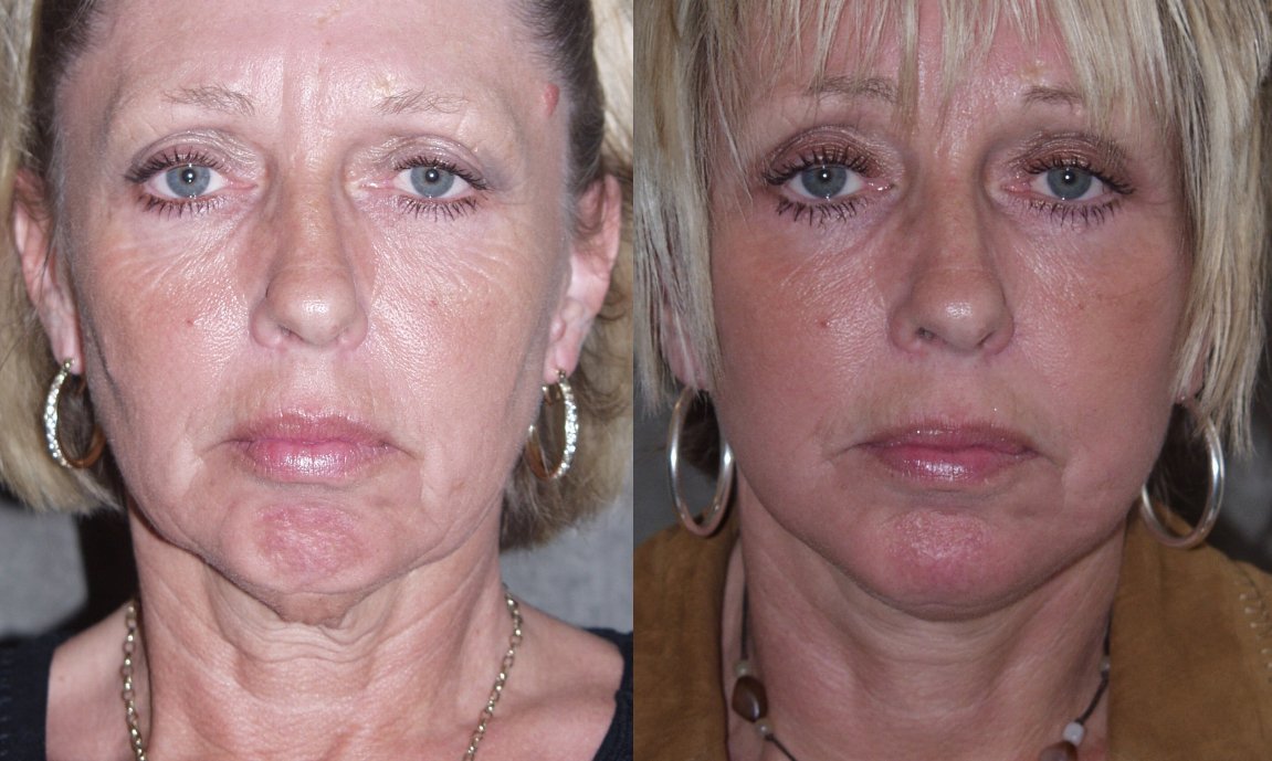 Chin augmentation before and after photographs, case 11, with the before photograph on the left and the after photograph on the right