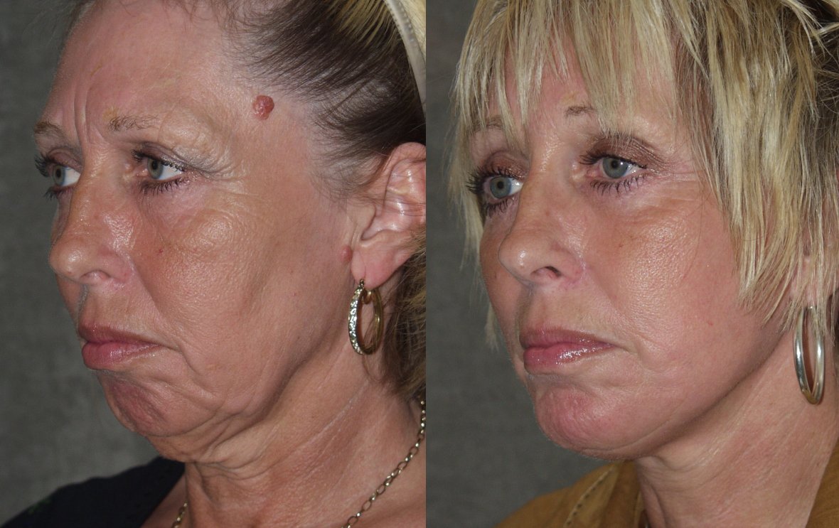 Chin augmentation before and after photographs, case 12, with the before photograph on the left and the after photograph on the right