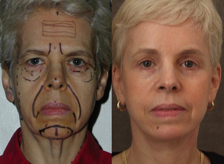 Facelift before and after photographs, case 3, with the before photograph on the left and the after photograph on the right