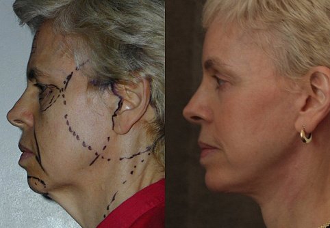 Facelift before and after photographs, case 4, with the before photograph on the left and the after photograph on the right