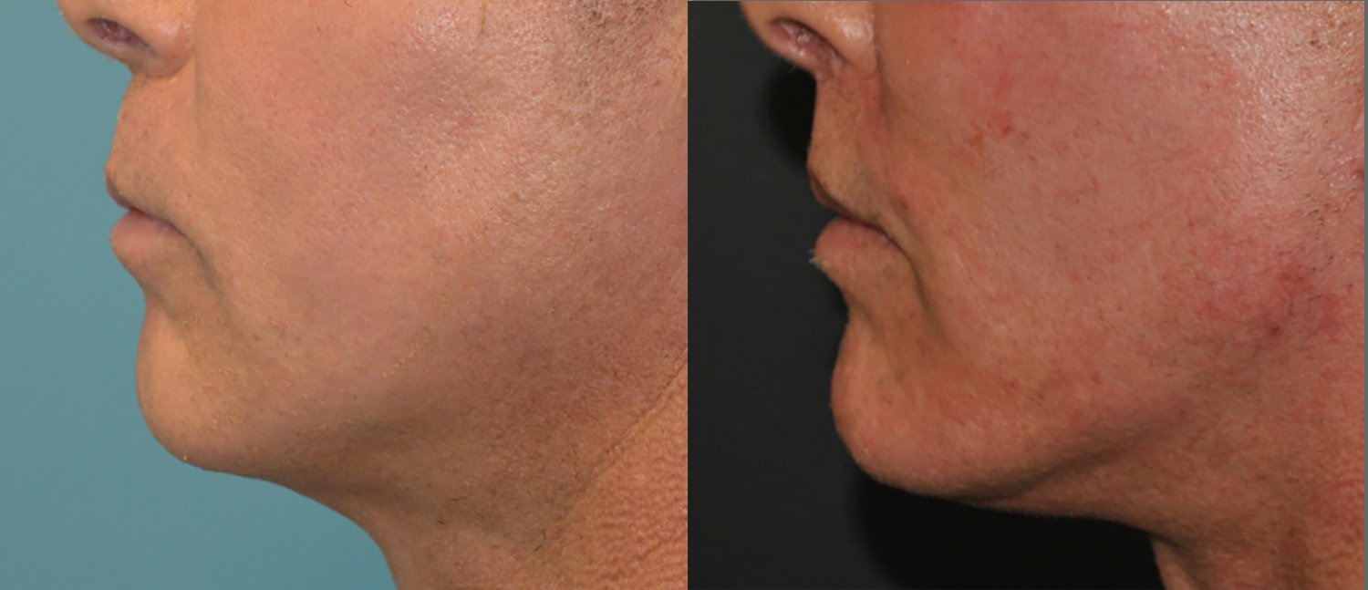 Chin augmentation before and after photographs, case 1, with the before photograph on the left and the after photograph on the right