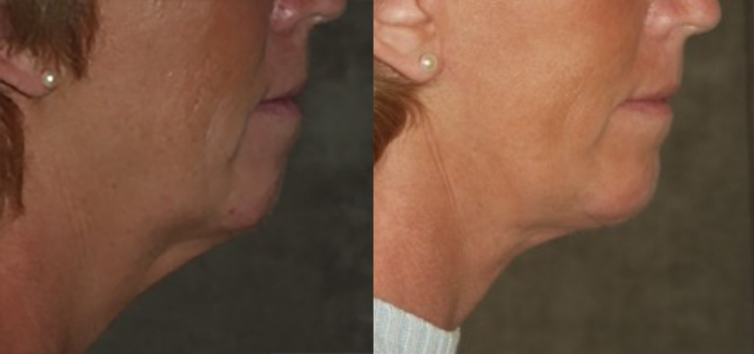 Dr. Kirwan patient result — Dr. Laurence Kirwan. Chin augmentation with facelift, 4 months post-op, side view. Before: left; After: right.