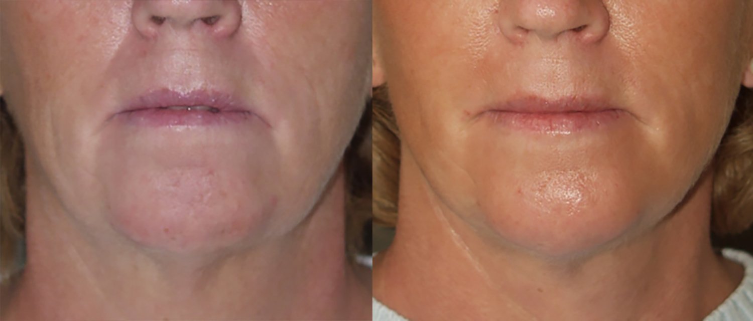 Dr. Kirwan patient result — Dr. Laurence Kirwan. Chin augmentation with facelift, 4 months post-op, front view. Before: left; After: right.