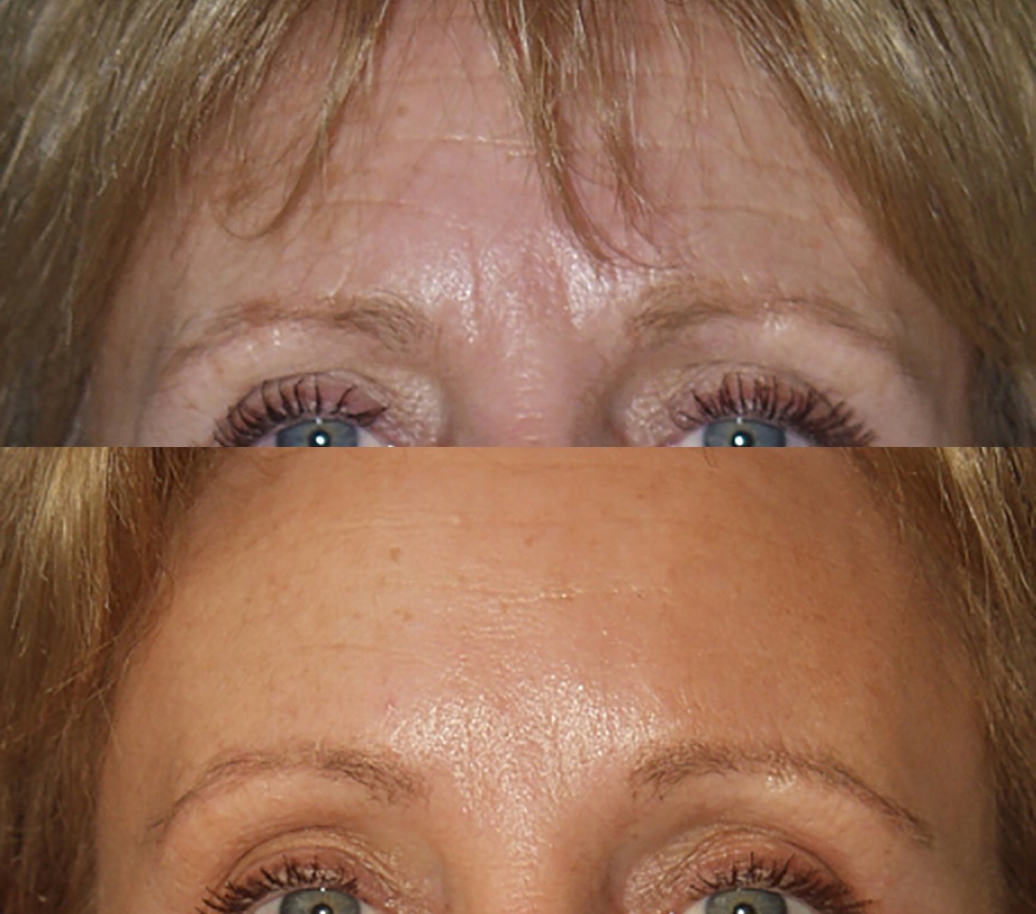 Brow lift before and after photographs, case 3, with the before photograph on top and the after photograph below