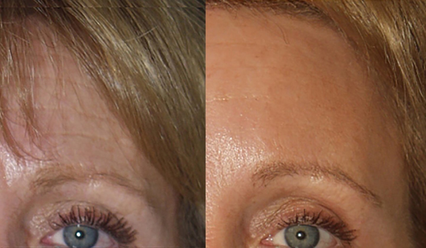 Brow lift before and after photographs, case 4, with the before photograph on the left and the after photograph on the right