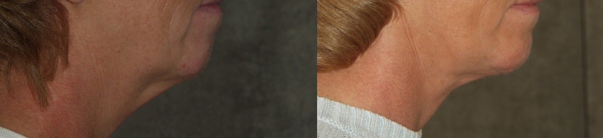 Dr. Kirwan patient result — Dr. Laurence Kirwan. Chin augmentation with facelift, 4 months post-op, jawline close-up. Before: left; After: right.