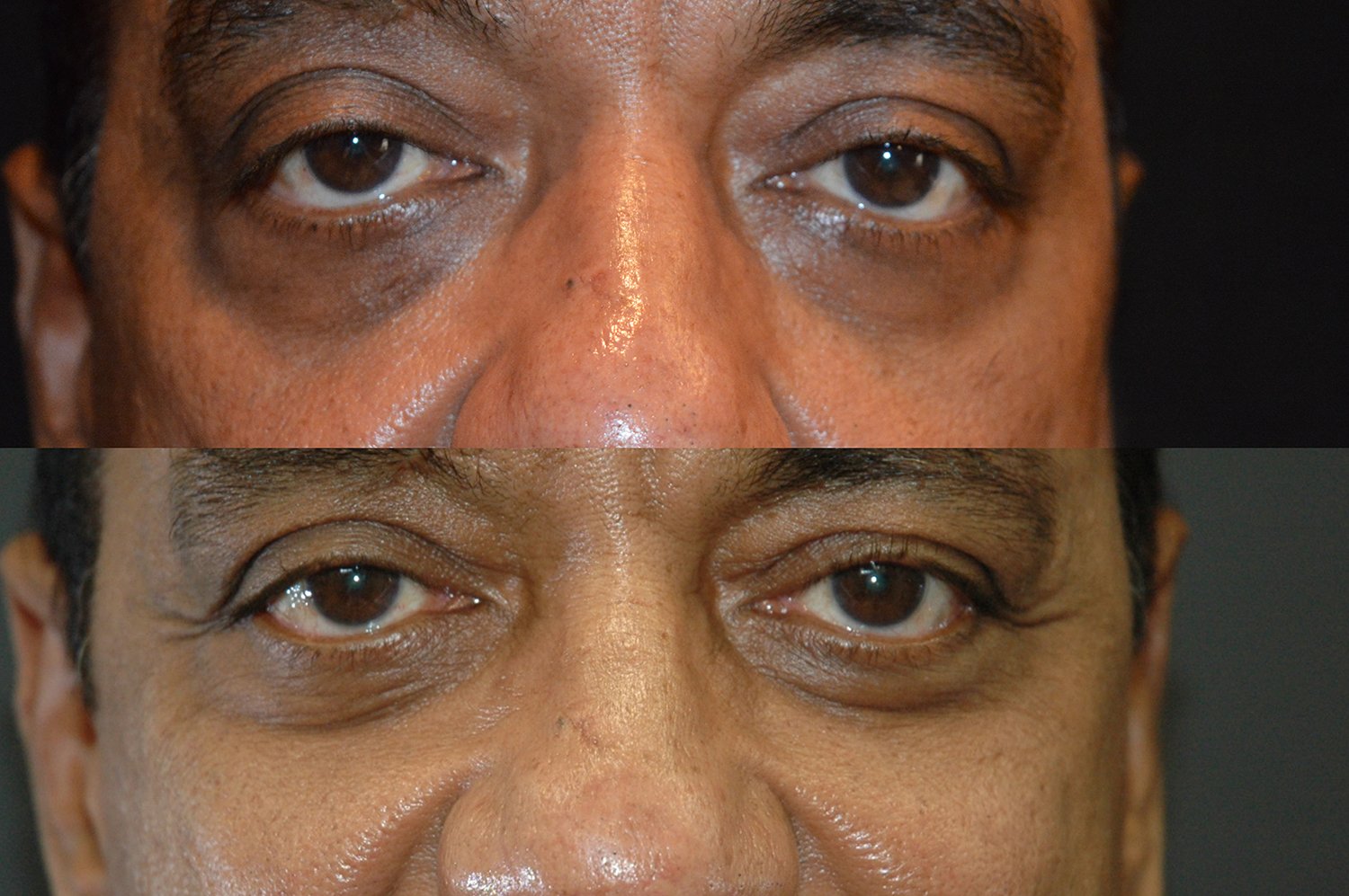 Blepharoplasty before and after photographs, case 11, with the before photograph on top and the after photograph below