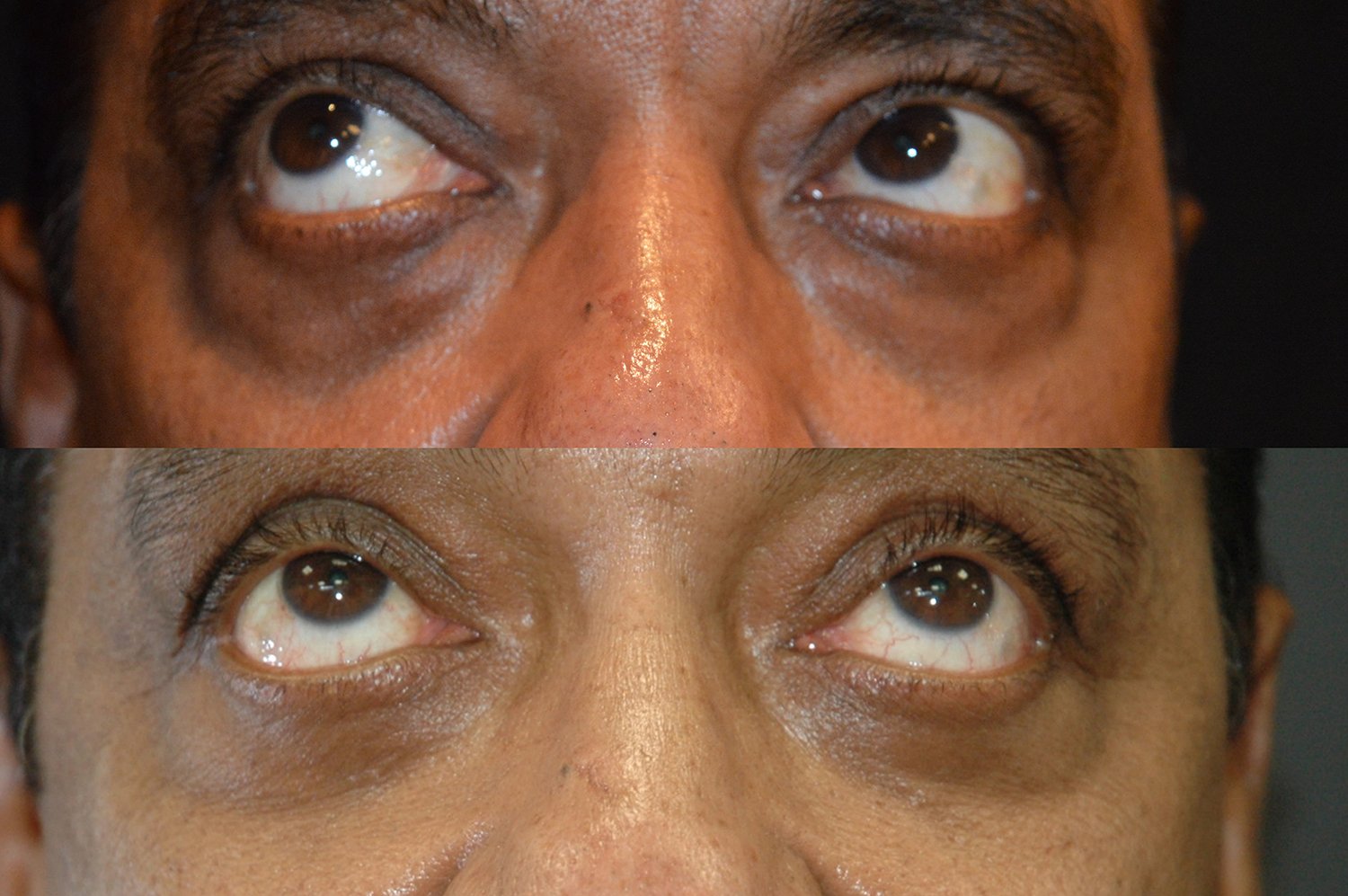 Blepharoplasty before and after photographs, case 12, with the before photograph on top and the after photograph below