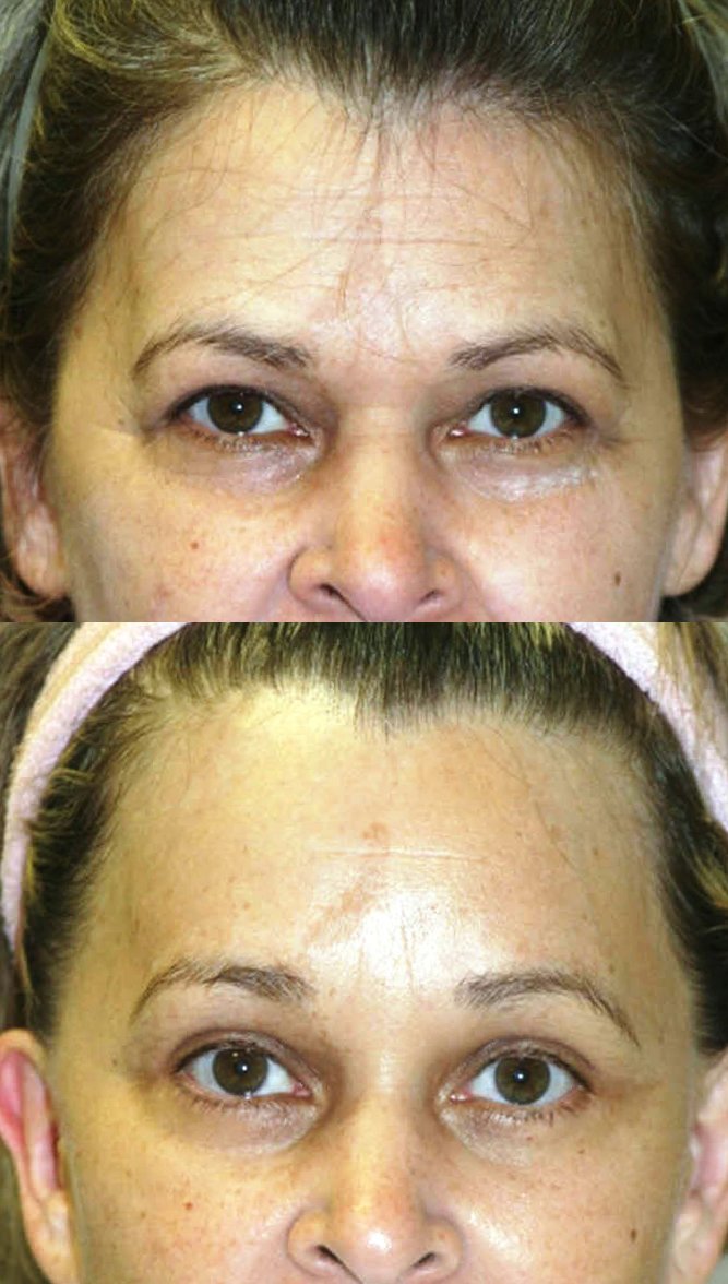 Brow lift before and after photographs, case 2, with the before photograph on top and the after photograph below